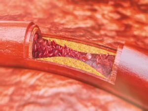 Atherosclerosis: Chelation therapy, Chelating Agents