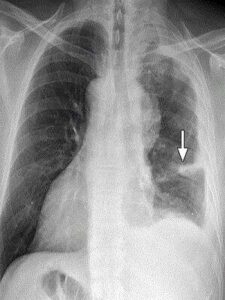 Mesothelioma 10 Treatment Options