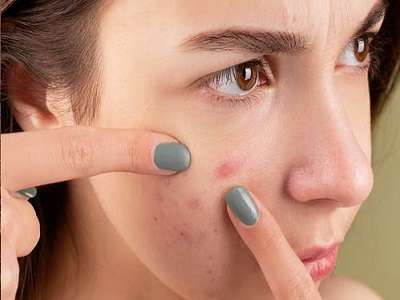 Acne on Face: Treatment, Causes & Prevention, Types of Pimples