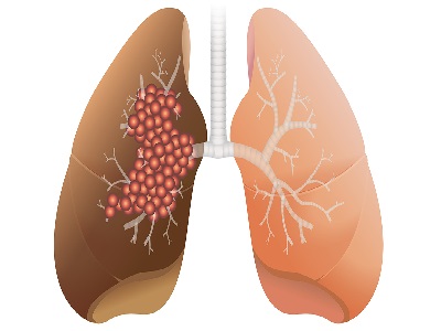 Lung Cancer: Symptoms, Causes, Survival Rate, Diagnosis, Treatment