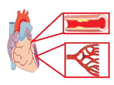 Prevent Acute Coronary Syndrome at Home