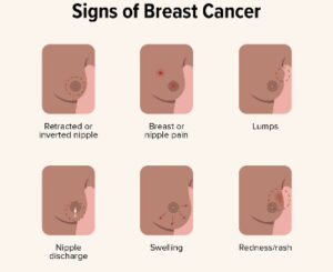 Breast Cancer Causes, Proven Tips for Prevention