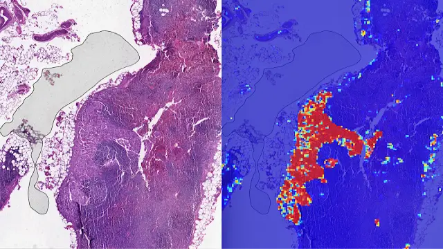 Google's AI can detect breast cancer