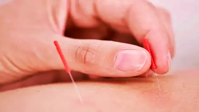 Unlocking the Secrets of Acupuncture