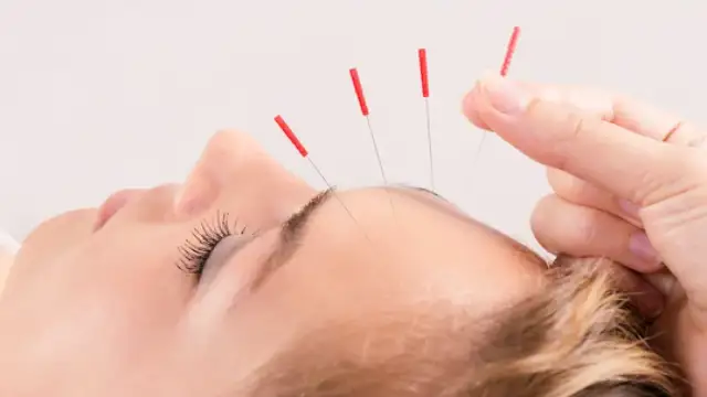 Acupuncture Can Help Treat Depression