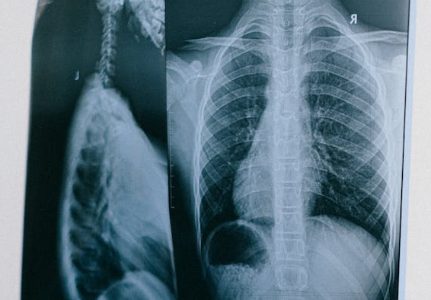 Corona and Tuberculosis