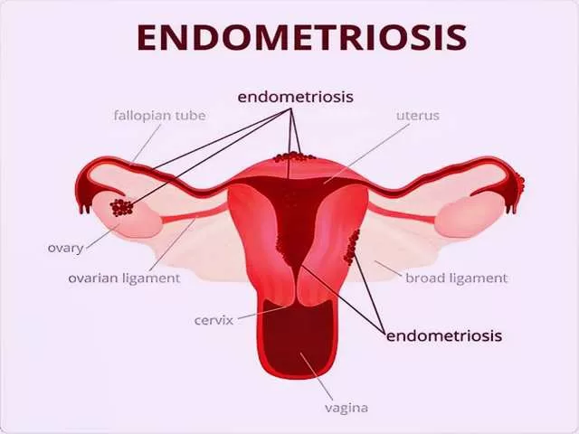 Endometriosis Diagnosing Treatments