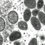 Deadly Mpox Variant