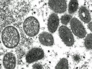 Deadly Mpox Variant